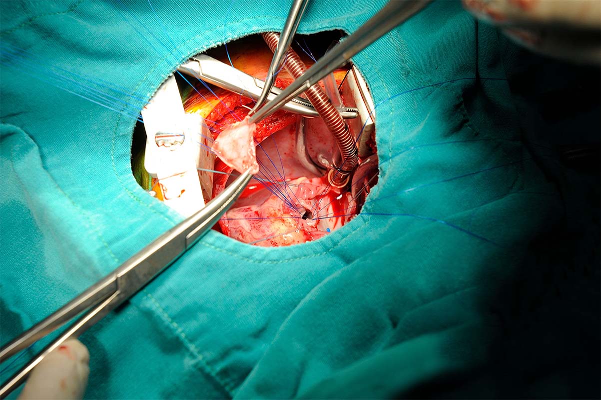 Close up of pediatric cardiac surgery.